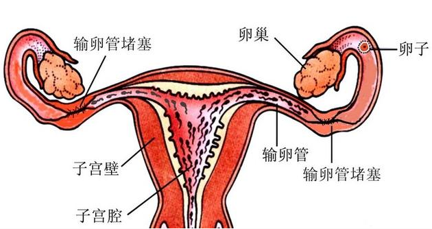 双侧输卵管堵塞会影响怀孕吗